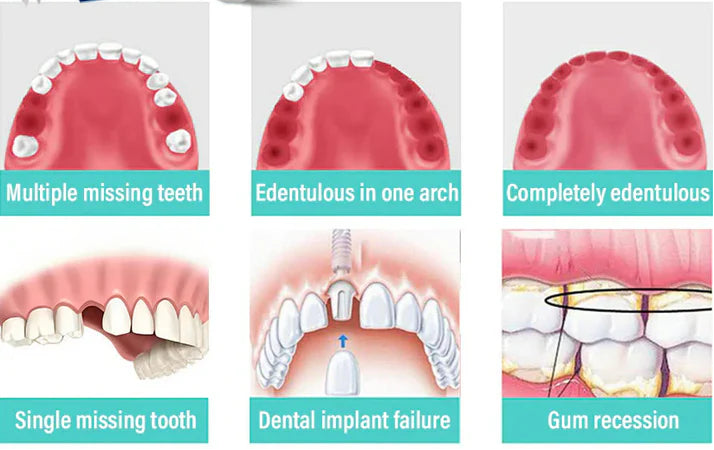 Glamora Adjustable Buckle Denture, Temporary Fillings Interdental Fillings Orthodontic Denture Kits