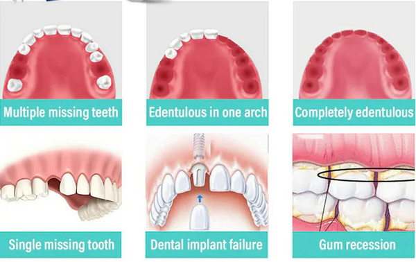 Glamora Adjustable Buckle Denture, Temporary Fillings Interdental Fillings Orthodontic Denture Kits